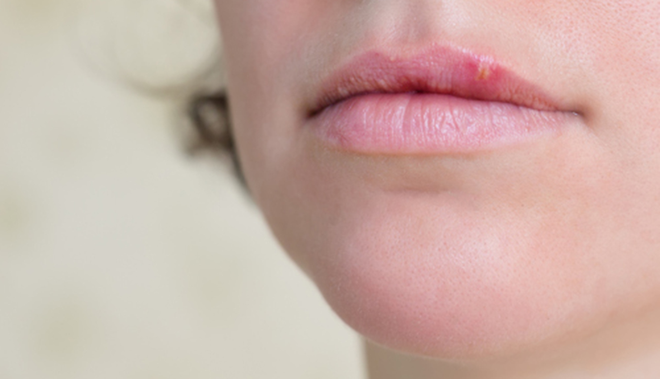 Bumps On Lips