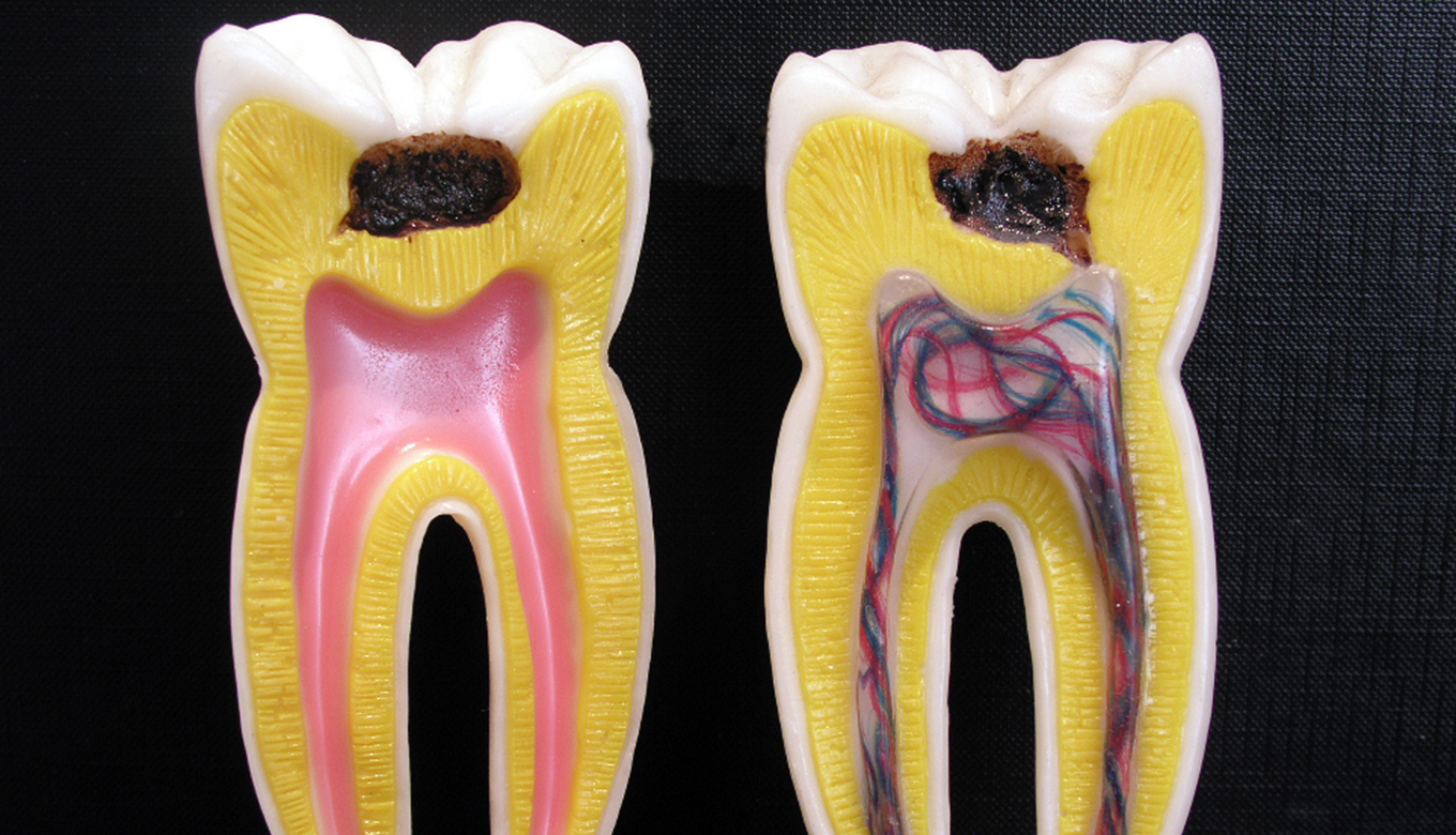 Tooth with infected pulp