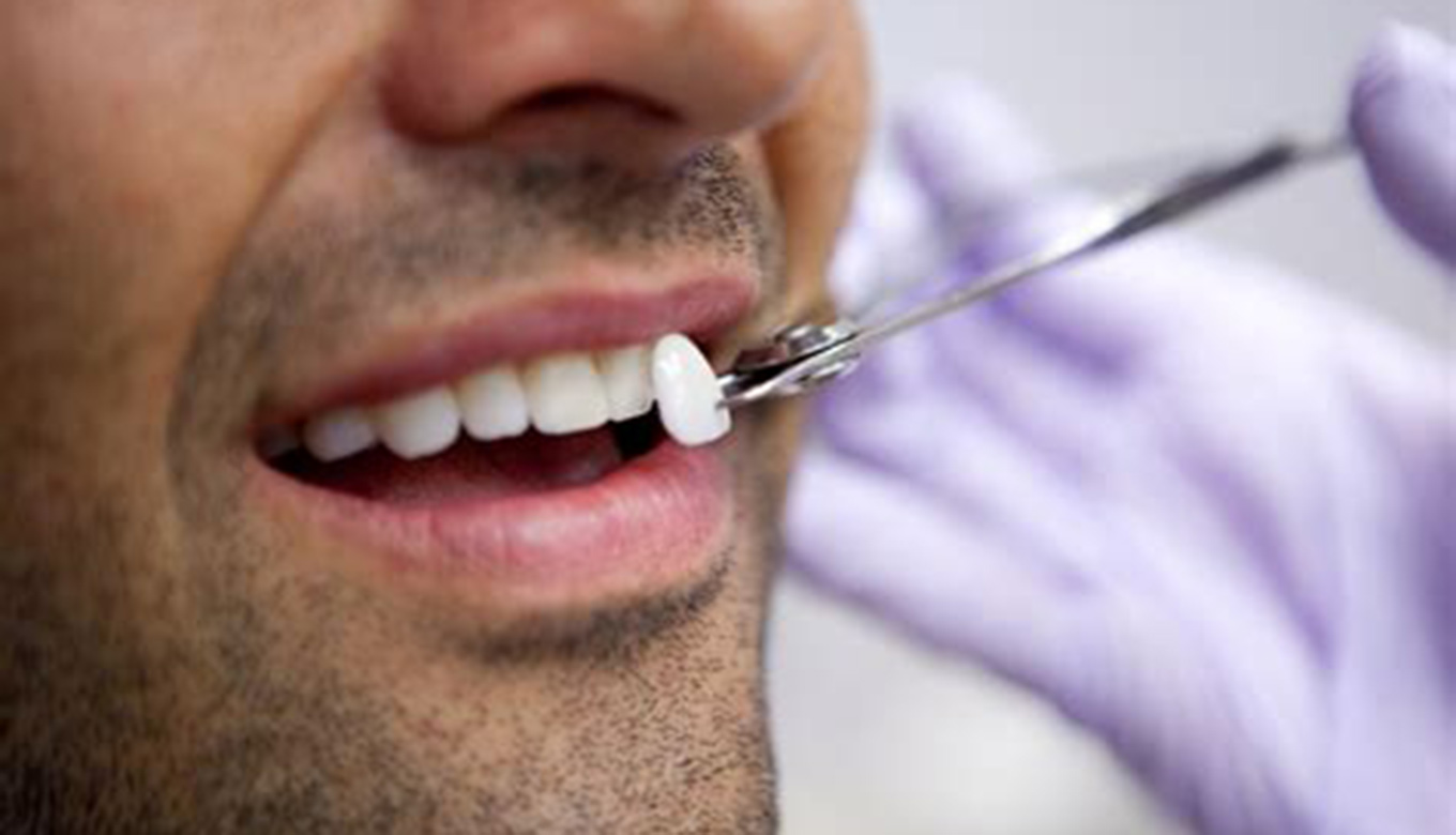 Why does a dental veneer need replacement? » Locus Dental Care
