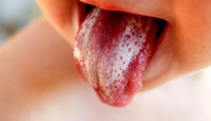 Oral Thrush