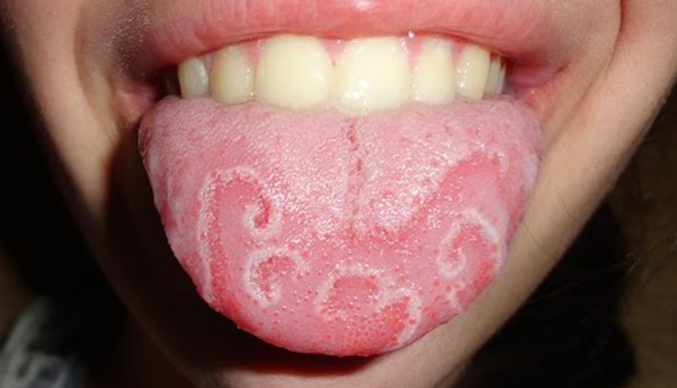 Geographic Tongue