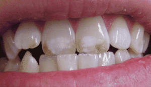 Dental Fluorosis