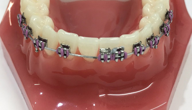 Broken Braces? What to do if a Bracket or Wire Breaks (Don't Panic!)