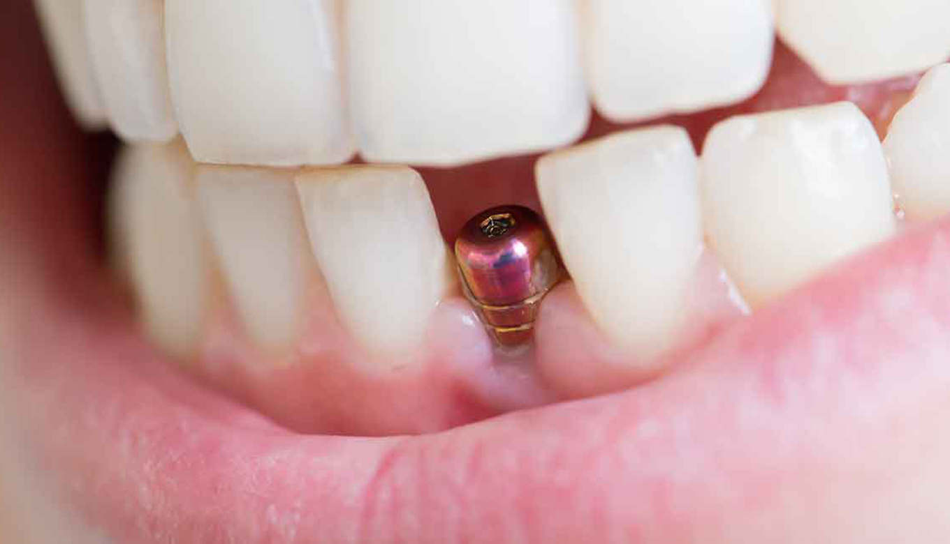 Fixed dental implant