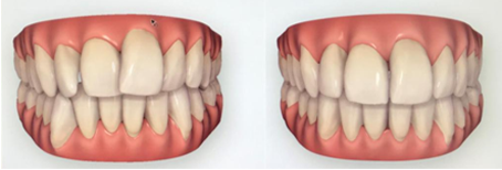 teeth-image